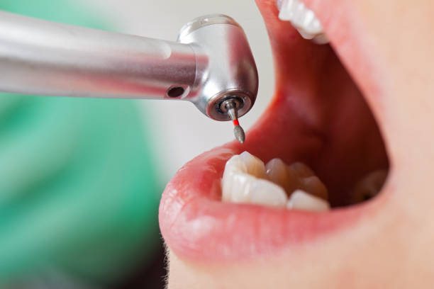 Best Emergency Tooth Extraction in Northlakes, NC